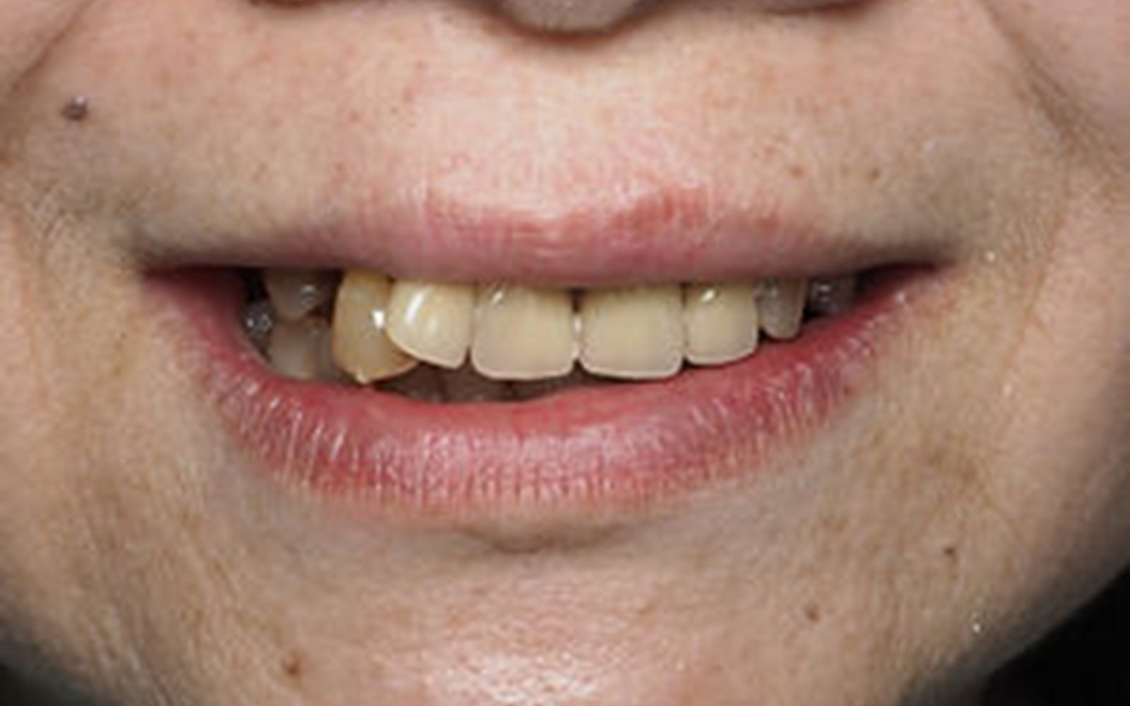 Dentist in Renton Benson Hill Smiles